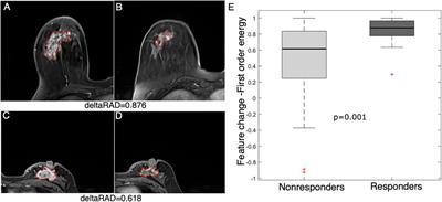 Radiomics of Tumor Heterogeneity in Longitudinal Dynamic Contrast-Enhanced Magnetic Resonance Imaging for Predicting Response to Neoadjuvant Chemotherapy in Breast Cancer